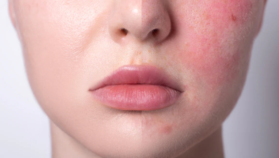 Skin redness