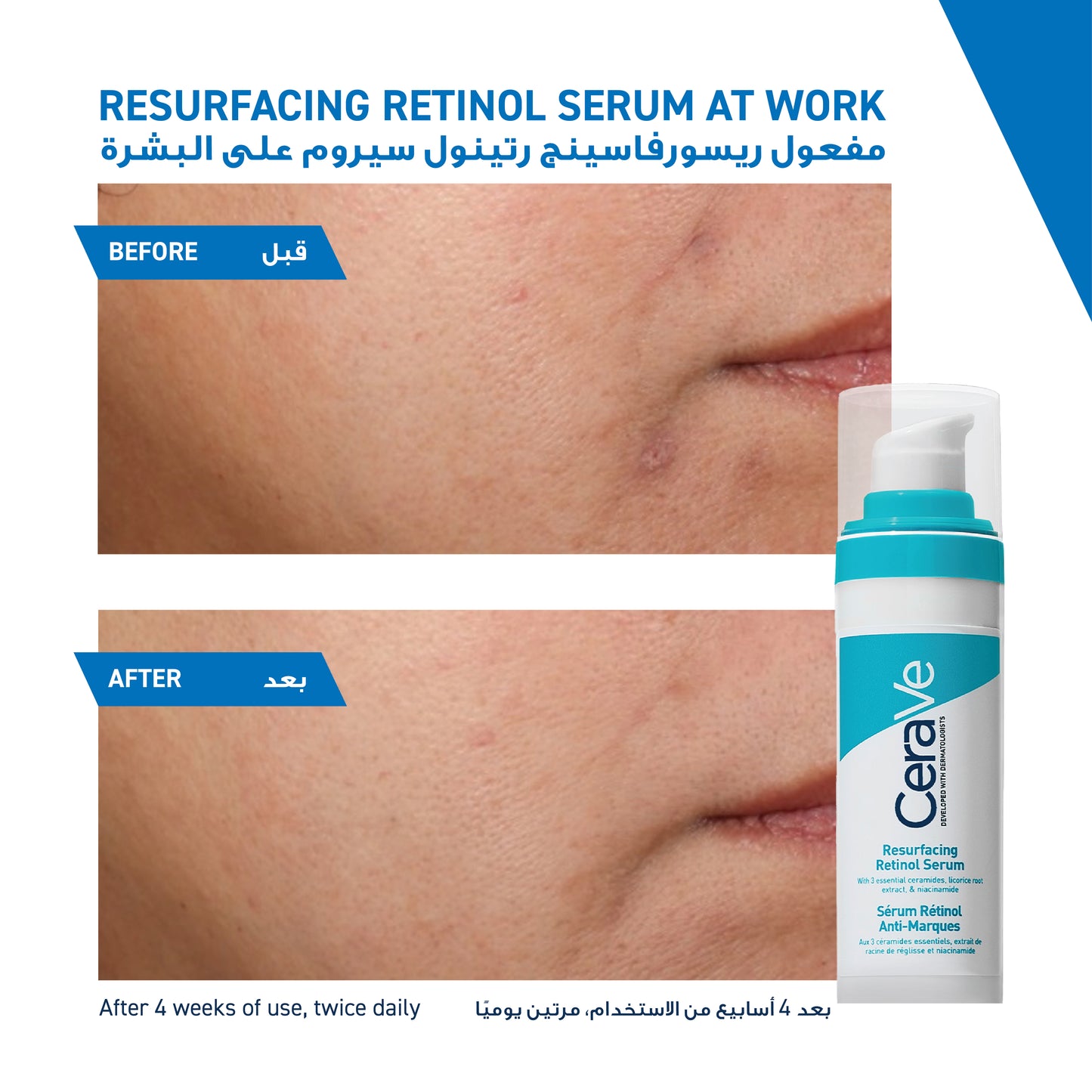 CERAVE RESURFACING RETINOL SERUM TO REDUCE THE APPEARANCE OF POST-ACNE MARKS AND PORES WITH RETINOL, LICORICE ROOT EXTRACT & NIACINAMIDE 30ML